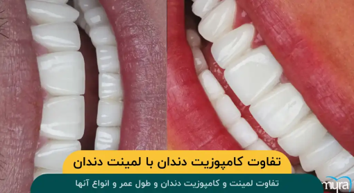 تفاوت-کامپوزیت-دندان-لمینت-دندان